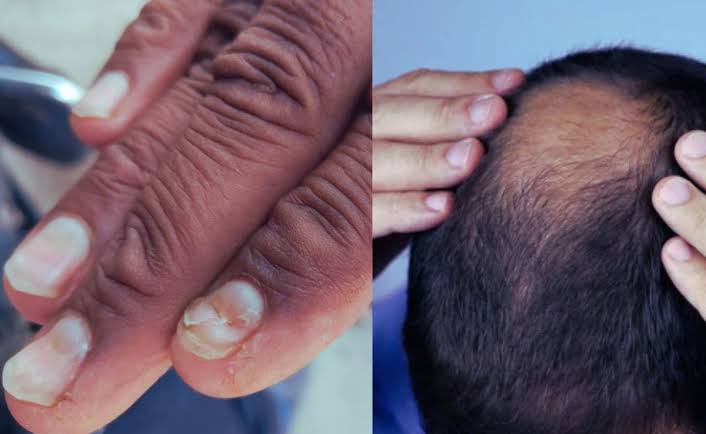 Maharashtra Health Scare: After Hair Loss, Buldhana Villagers Now Suffer Nail Loss